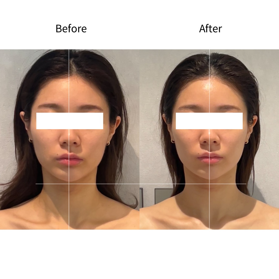 중안부 길이 얼굴균형 Before & After