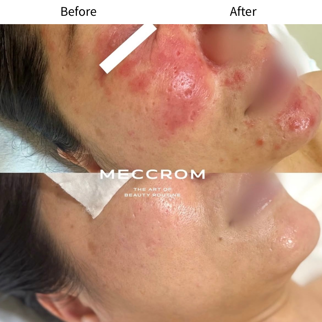 트러블 · 예민 피부 케어